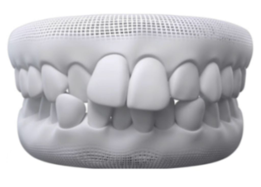Crowded Teeth