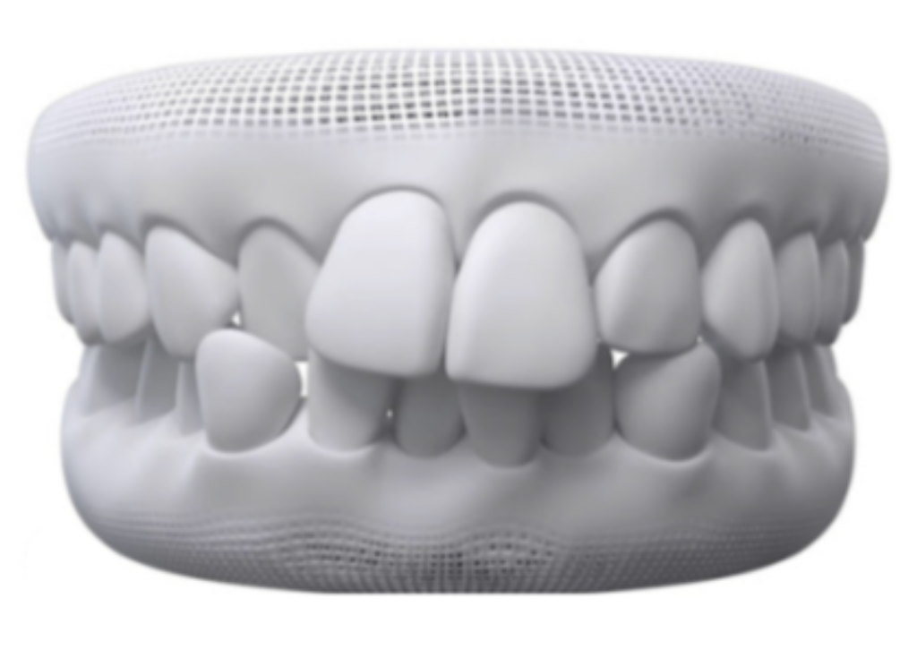Overbite